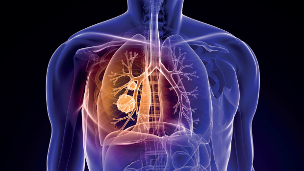 Leiden Sie an Asthma oder COPD?
