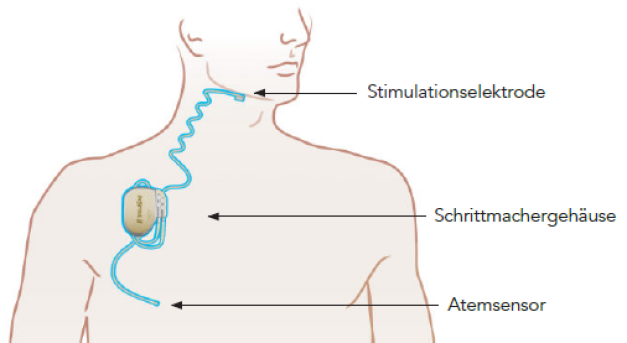 Therapie Stimulation der Atemwegsmuskulator