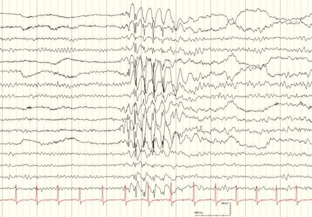 Elektorenzephalographie mit epilepsie-typischen Potentialen